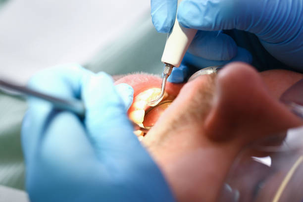 Best Emergency Tooth Extraction in Toronto, OH